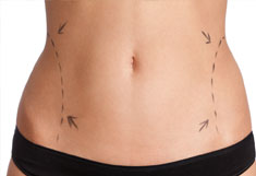 liposuction in India liposuction in India