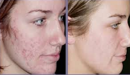 Acne Scars treatment in Delhi