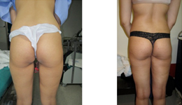 Brazilian Butt lift Surgery in Delhi Brazilian Butt lift Surgery in Delhi