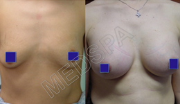 Breast Augmentation Surgery in Delhi Breast Augmentation Surgery in Delhi