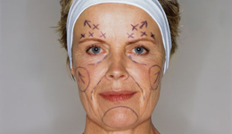 Invassive Facial Rejuvenation