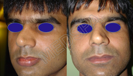 Lip Reduction Surgery Lip Reduction Surgery