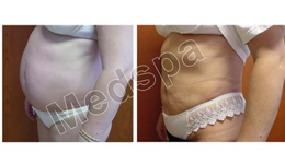 Liposuction Surgery in Delhi Liposuction Surgery in Delhi