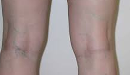 Sclerotherapy Treatment in Delhi