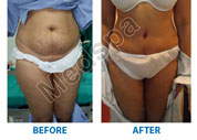 abdominoplasty surgery in Delhi