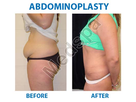 Breast Lift Surgery in India Tummy Tuck Surgery in India