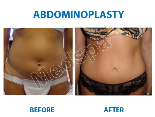 Abdominoplasty Surgery Abdominoplasty Surgery