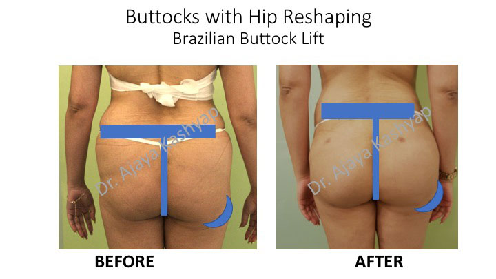 buttock lift surgery in Delhi buttock lift surgery in Delhi