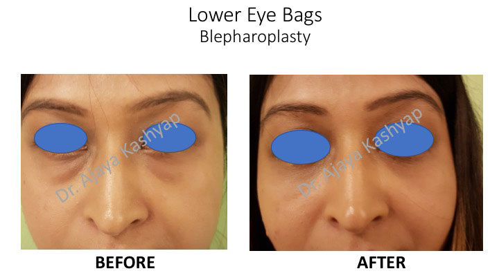 blepharoplasty surgery in India blepharoplasty surgery in India