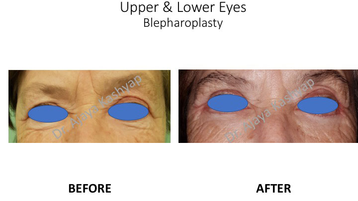 eyelid surgery in India eyelid surgery in India