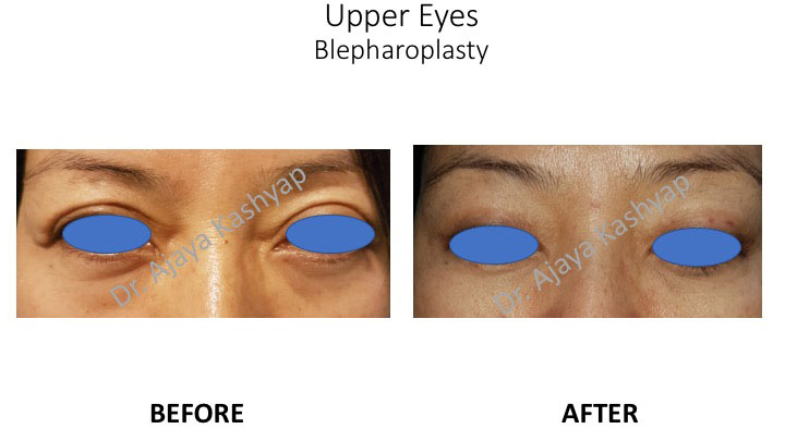 eyelid surgery in Delhi eyelid surgery in Delhi