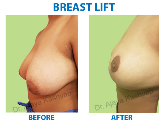 Breast Lift Breast Lift