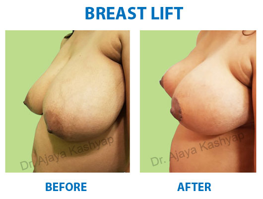 Breast Lift Surgery in India Breast Lift Surgery in India