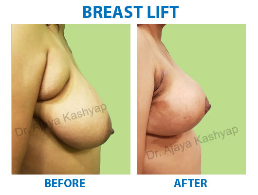 Breast Lift Surgery Breast Lift Surgery