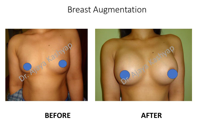 Breast Augmentation Breast Augmentation