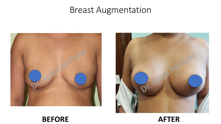 Breast Augmentation Surgery in India Breast Augmentation Surgery in India