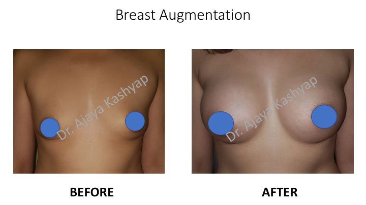 Breast Augmentation Surgery Breast Augmentation Surgery