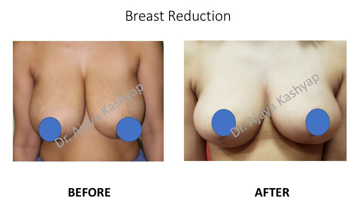 Breast Reduction Breast Reduction