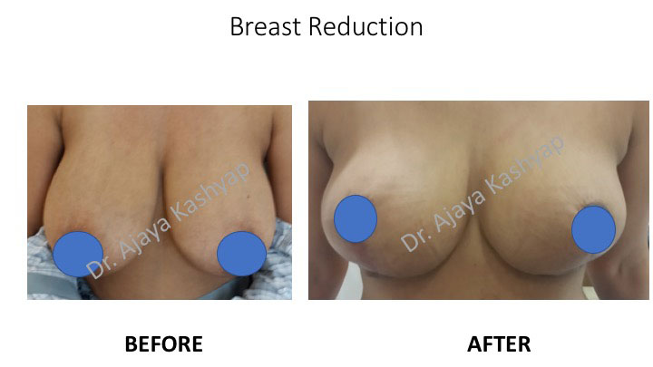 Breast Reduction Surgery in India Breast Reduction Surgery in India