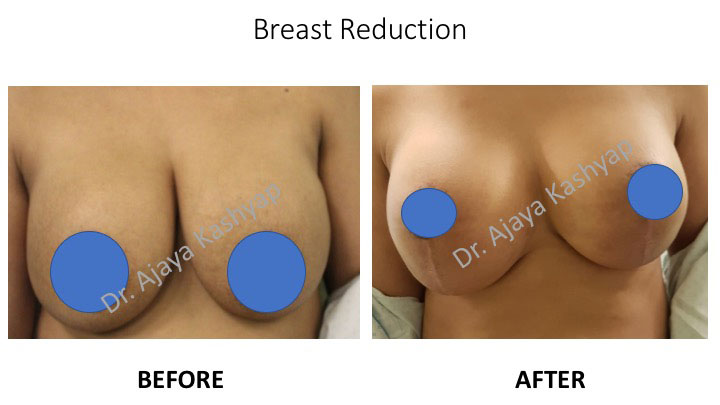 Breast Reduction Surgery Breast Reduction Surgery