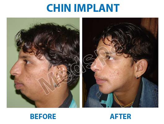 rhinoplasty surgery in Delhi chin implant cost in Delhi