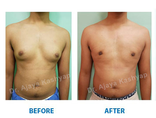 Gynecomastia Surgery in Delhi Gynecomastia Surgery in Delhi