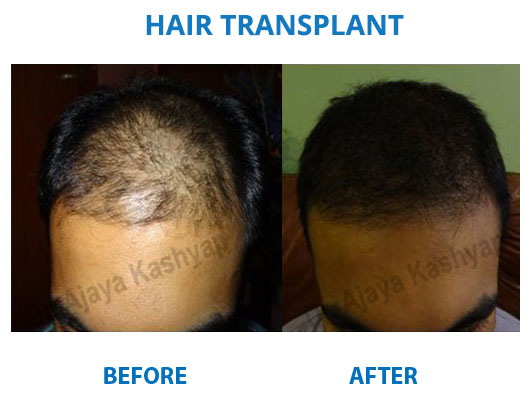 Hair Transplant Surgery in Delhi Hair Transplant Surgery in Delhi