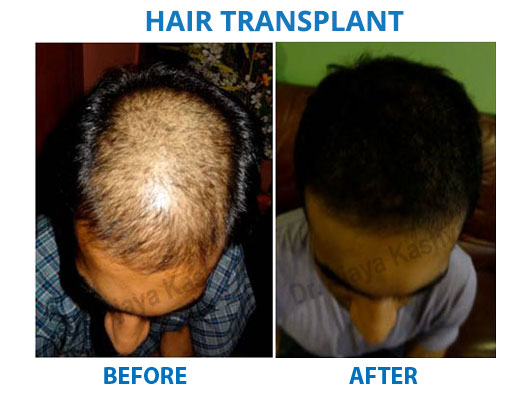 FUE hair transplant surgery in Delhi