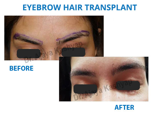 eyebrows transplant surgery in India