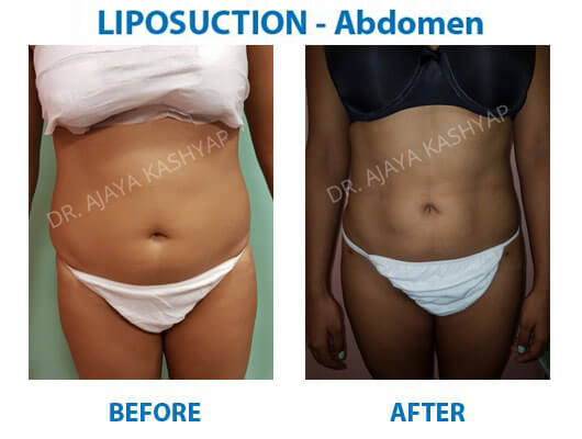 Liposuction Surgery in Delhi Liposuction Surgery in Delhi