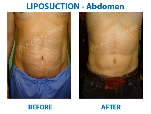 Liposuction Liposuction