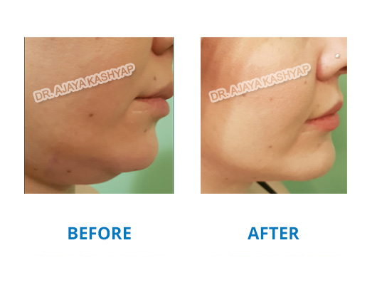 Liposuction Surgery in India Liposuction Surgery in India