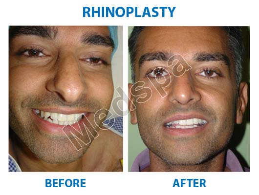 nose surgery in Delhi nose surgery in Delhi