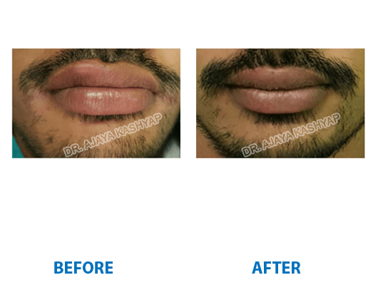 Lip Reduction Surgery in India Lip Reduction Surgery in India