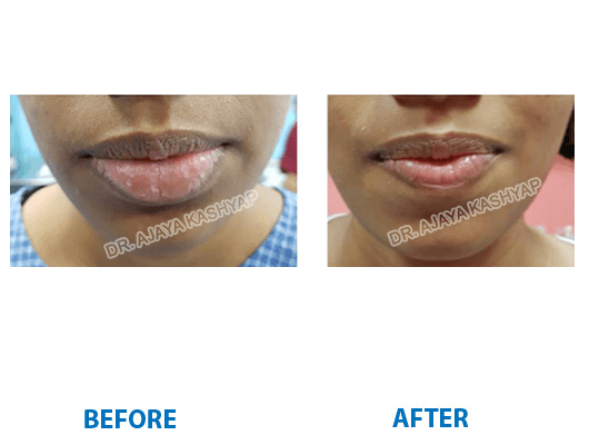 Lip Reduction