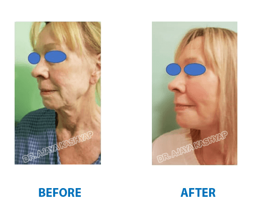 facelift surgery facelift surgery