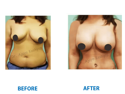 mommy makeover in Delhi mommy makeover in Delhi