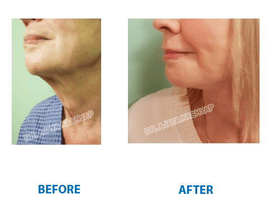 neck lift surgery neck lift surgery