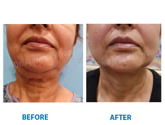 neck lift surgery in India neck lift surgery in India