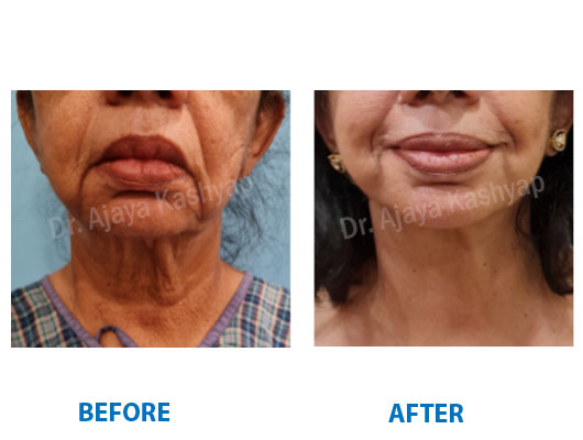 neck lift surgery neck lift surgery