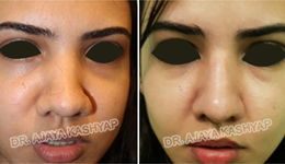 rhinolasty surgery in India rhinolasty surgery in India