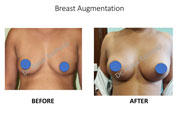 Breast Augmentation surgery
