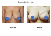 Breast Reduction surgery