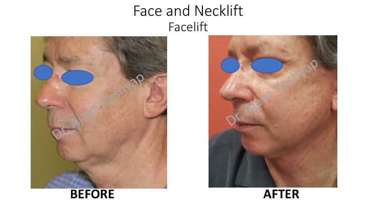 facelift Surgery in India