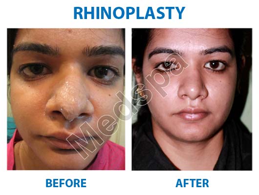 nose job surgery in Delhi
