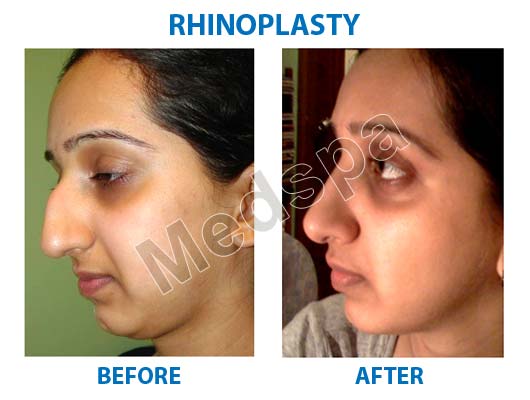 Best Rhinoplasty Surgery in Delhi, Nose Surgery Cost in India