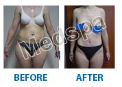total body contouring