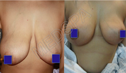 Breast Lift Surgery in Delhi
