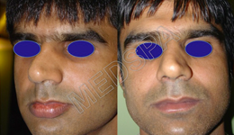 Lip Reduction surgery in Delhi
