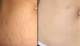 stretch mark treatment in Delhi